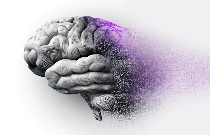 آلزایمر